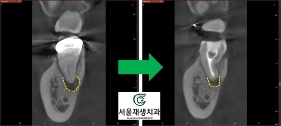 [재신경치료] 치과 종사자도 찾아오는 신경치료 전문치과, 서울재생치과! 관련 이미지 9