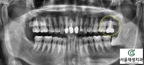 [재신경치료] 40대 남성, 윗 어금니 신경치료 후 상악동까지 염증이 전파된 사례 (서울재생치과 미세현미경치료) 관련 이미지 3