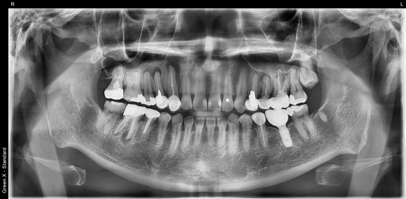 [재신경치료] 신경치료 받은 치아가 아프고 흔들려요 (ft. Zeiss미세현미경) 관련 이미지 2