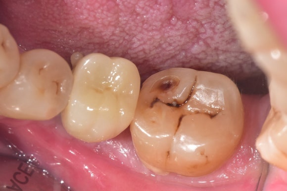 [임플란트] 이가 빠진지 오래되서 옆 치아들이 쓰러졌어요. 임플란트 가능할까요? 네, 가능합니다.1mm의 정교함으로! 관련 이미지 8