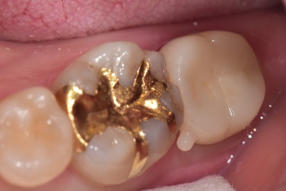 [재신경치료] 잇몸이 부었어요. 다니던 치과에서는 재신경치료 하거나 발치하라고 했어요. 관련 이미지 10