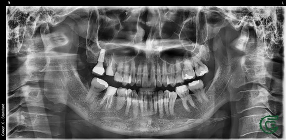 [재신경치료] 대학병원에서도 포기한 어금니...(재)재신경치료로 살려낸 이야기. (미세현미경Zeiss사용) 관련 이미지 4