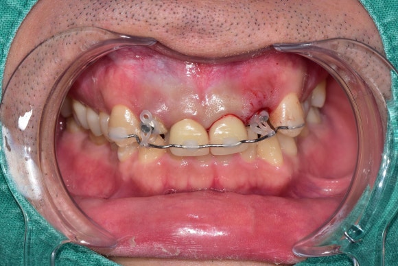 [치아살리기] 크라운 씌운 치아가 부러졌어요. 교정적정출술을 통해 내 치아 끝까지 써보기 관련 이미지 4