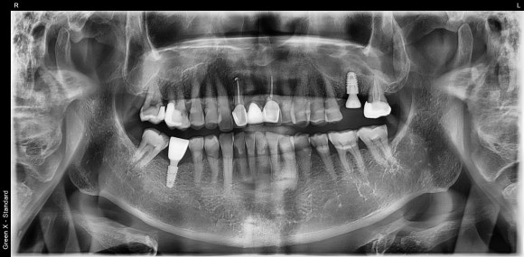 [임플란트] 이가 빠진지 오래되서 옆 치아들이 쓰러졌어요. 임플란트 가능할까요? 네, 가능합니다.1mm의 정교함으로! 관련 이미지 10