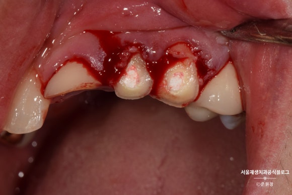[치아외상] 부러진 앞니, 발치가 답인가요? (사고로 부러진 치아, 외과적정출술로 살리기) 관련 이미지 15