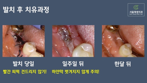 [발치 후 치유과정] 이를 뺀 후 아무는 과정, 단계별 주의사항 (신촌 서울재생치과) 관련 이미지 6
