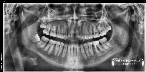 [재신경치료] 예전에 신경치료 받은 치아가 갑자기 붓고 아파요! (현미경을 통해 정확하고 섬세하게 재신경치료 하기) 관련 이미지 7