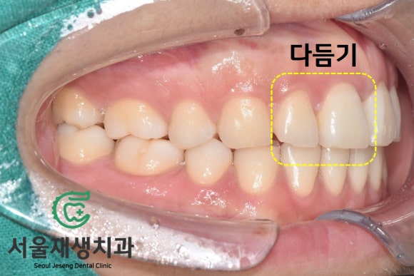 [깨진앞니치료] 살짝 다듬고, 살짝 때우고! (서울재생치과 신촌) 관련 이미지 6