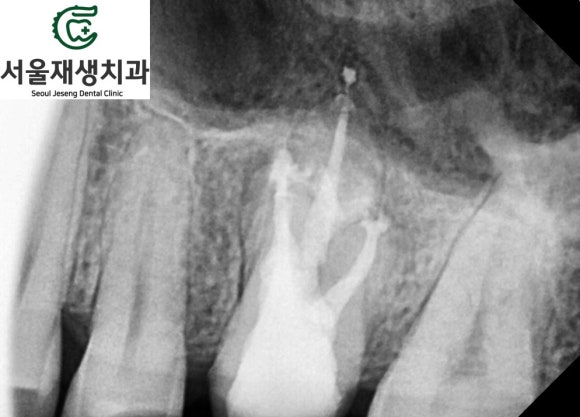 [재신경치료] 재신경치료까지 했는데 계속 아파요..미세 현미경을 이용한 세번째 신경치료! (서울재생치과) 관련 이미지 11