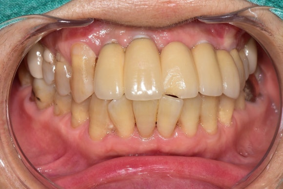 [앞니치료] 앞니에 씌운 도자기가 깨졌을 때, 새로 만드는 대신 수리해서 쓰는 법 (도자기파절, 레진치료) 관련 이미지 3