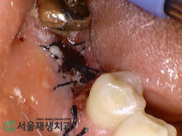 [발치 후 치유과정] 이를 뺀 후 아무는 과정, 단계별 주의사항 (신촌 서울재생치과) 관련 이미지 3