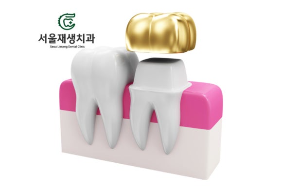 이갈이, 이악물기로 치아가 깨졌어요. 어떻게 치료하나요? (크라운치료 장단점, 레진치료 장단점, 신촌치과,서울재생치과,치아파절,어금니치료) 관련 이미지 3