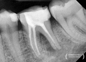 [재신경치료] 예전에 신경치료 받은 치아가 갑자기 붓고 아파요! (현미경을 통해 정확하고 섬세하게 재신경치료 하기) 관련 이미지 11