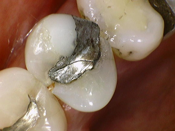A Tooth Filled with Amalgam Long Ago Has Cracked. image 3