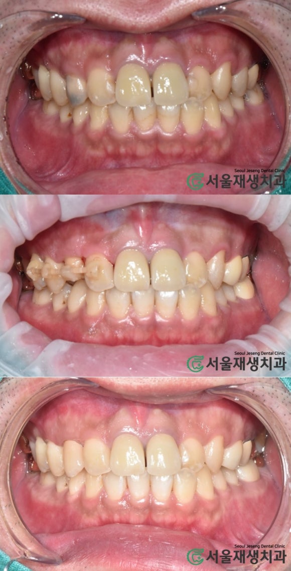 [치아정출술] 충치가 뿌리까지 진행되서 발치해야 한대요...뿌리 깊은 충치도 살려내기 (서울재생치과) 관련 이미지 14