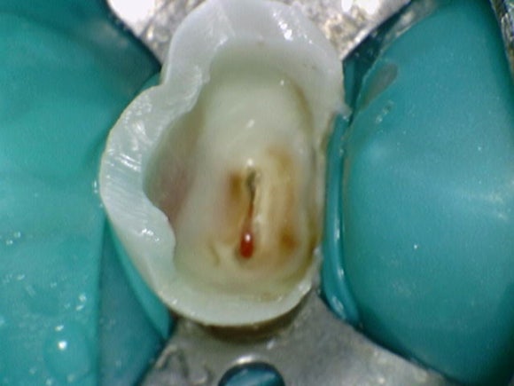 [신경치료] 충치가 커서 뿌리만 남았대요. 비발치 신경치료로 자연치아 살리기! 관련 이미지 5