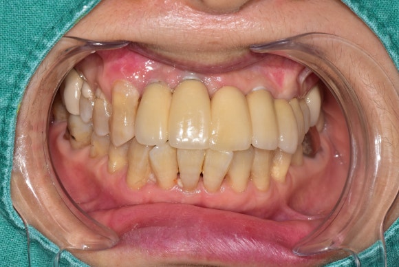 [앞니치료] 앞니에 씌운 도자기가 깨졌을 때, 새로 만드는 대신 수리해서 쓰는 법 (도자기파절, 레진치료) 관련 이미지 4