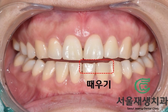[깨진앞니치료] 살짝 다듬고, 살짝 때우고! (서울재생치과 신촌) 관련 이미지 5
