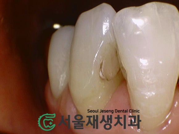 [충치치료] 앞니 충치&middot;오래되어 변색된 재료를 레진으로 해결! 관련 이미지 3