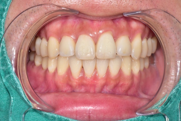 얼룩덜룩한 흰반점, white spot을 치료하는 법 (무삭제 충치치료) 관련 이미지 9