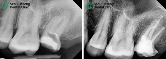 [재신경치료] 타치과에서 재신경치료 하는 중인데 발치를 하자고 했어요... (서울재생치과 현미경 신경치료) 관련 이미지 8
