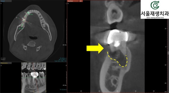 [재신경치료] 신경치료 받은 치아가 붓고 아파요! 현미경과 CT의 도움으로 다시 한 번 꼼꼼하게~ 관련 이미지 7