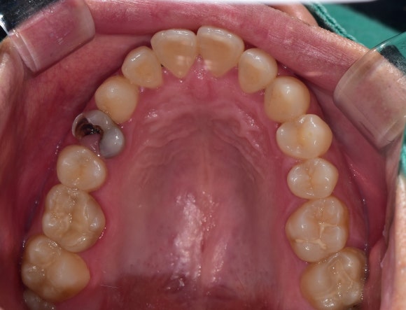 [신경치료] 충치가 커서 뿌리만 남았대요. 비발치 신경치료로 자연치아 살리기! 관련 이미지 4