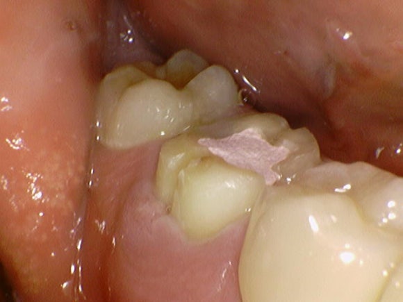 [재신경치료] 6개월 전에 신경치료한 치아에서 고름이 나와요. 관련 이미지 7
