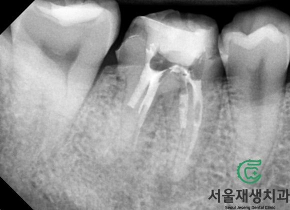 [재신경치료] 3년 전에 신경치료 했던 치아인데 다시 아파요! (미세 현미경 재신경치료, 서울재생치과) 관련 이미지 6