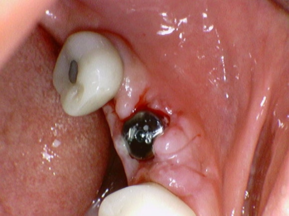 [임플란트] 재신경치료를 시도할 수 없을 때. 뼈이식 없는 임플란트 시술로 간편하게. 관련 이미지 10