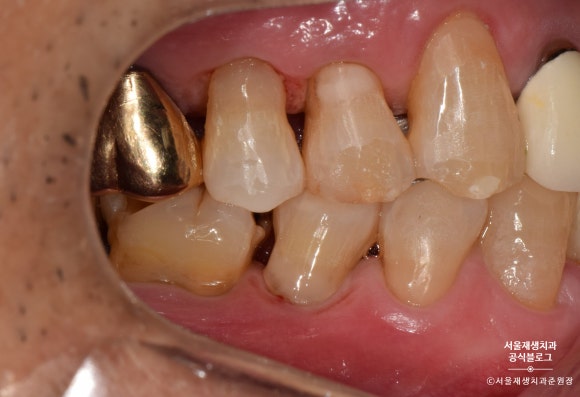 잇몸 패임, 무슨 재료로 때우나요? 레진과 글라스아이오노머(GI)로 치경부마모증 치료하기 (서울재생치과,신촌치과) 관련 이미지 25