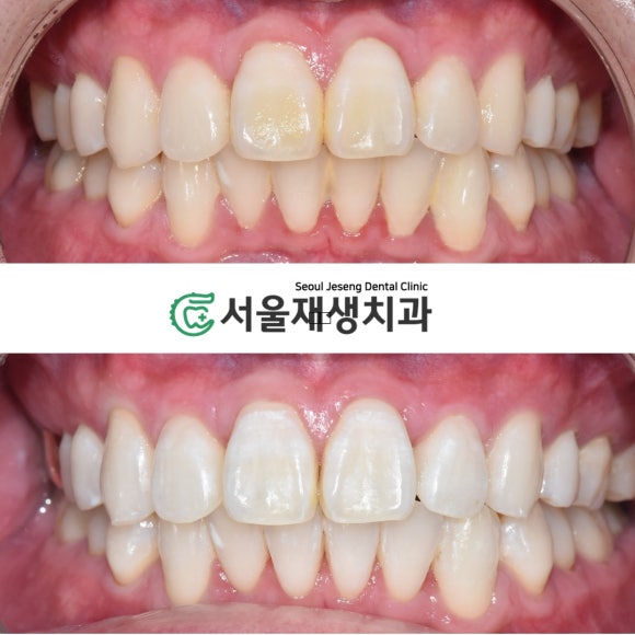 치아미백에 관한 거의 모든 것 (자주 묻는 질문, 시술 방법, 주의사항, 임산부, 수유부, 이시림, 피해야할 음식) 관련 이미지 6