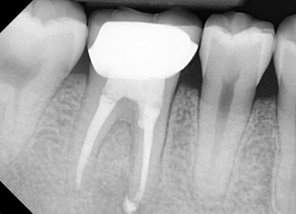 [재신경치료] 20대 남성, 9년 전에 신경치료한 치아에서 고름이 나와요. 관련 이미지 11