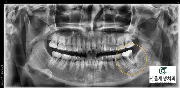 [재신경치료] 치과 종사자도 찾아오는 신경치료 전문치과, 서울재생치과! 관련 이미지 3