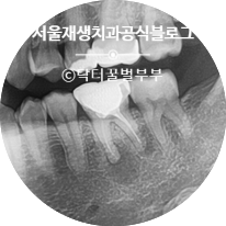 [재신경치료] 신경치료 받은 치아인데 잇몸에 뾰루지가 올라왔어요. (신촌 재신경치료 맛집, 신촌 서울대 보존과 전문의, 치근단 염증) 관련 이미지 4
