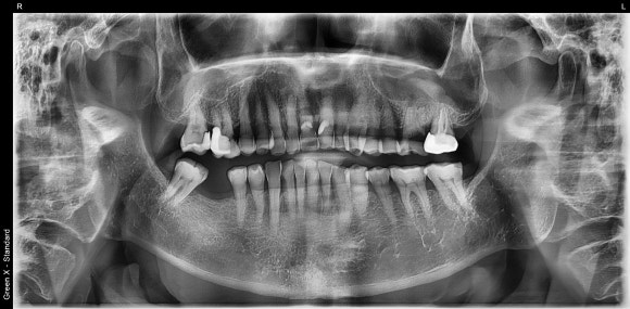 [임플란트] 이가 빠진지 오래되서 옆 치아들이 쓰러졌어요. 임플란트 가능할까요? 네, 가능합니다.1mm의 정교함으로! 관련 이미지 3
