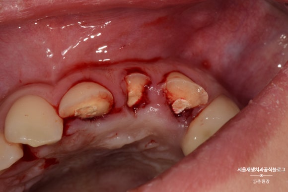 [치아외상] 부러진 앞니, 발치가 답인가요? (사고로 부러진 치아, 외과적정출술로 살리기) 관련 이미지 4