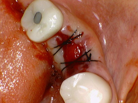 [임플란트] 재신경치료를 시도할 수 없을 때. 뼈이식 없는 임플란트 시술로 간편하게. 관련 이미지 6