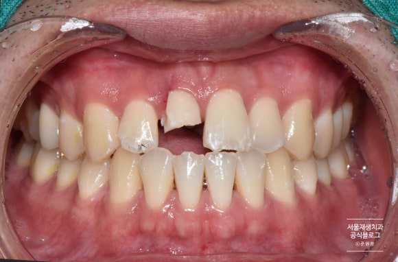 넘어져서 이가 여러군데 깨졌어요ㅠ (치아외상토탈케어, 서울재생치과, 치아 부러짐, 치아 파절) 관련 이미지 2