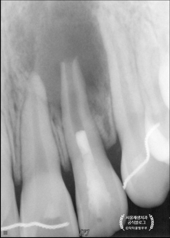 [재생근관치료] 이가 난지 얼마 안 됐는데 신경이 죽었대요...(소아 치아 외상, 치수 괴사, 미성숙 영구치, 신경재생술, REP, 치료기간, MTA 신경치료, 내원횟수) 관련 이미지 10