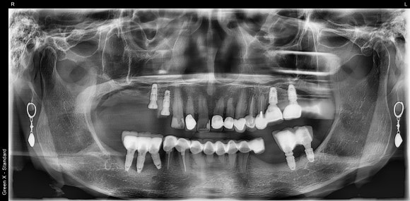 크라운 다음은 임플란트인가요...? (크라운 밑으로 생긴 충치, 크라운 다음엔 어떤 치료를...?, 자연치아 살리는 치과, 서울재생치과) 관련 이미지 2