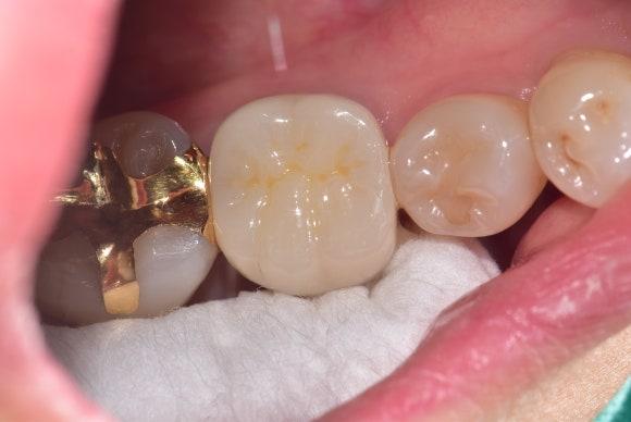 [재신경치료] 대학병원에서도 포기한 어금니...(재)재신경치료로 살려낸 이야기. (미세현미경Zeiss사용) 관련 이미지 5