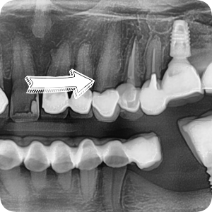 크라운 다음은 임플란트인가요...? (크라운 밑으로 생긴 충치, 크라운 다음엔 어떤 치료를...?, 자연치아 살리는 치과, 서울재생치과) 관련 이미지 3