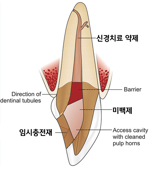치아가 변색되면 무조건 크라운을 해야 하나요? (치아 미백, 실활치 미백, 신경치료 후 미백, 신촌치과추천,서울재생치과) 관련 이미지 4