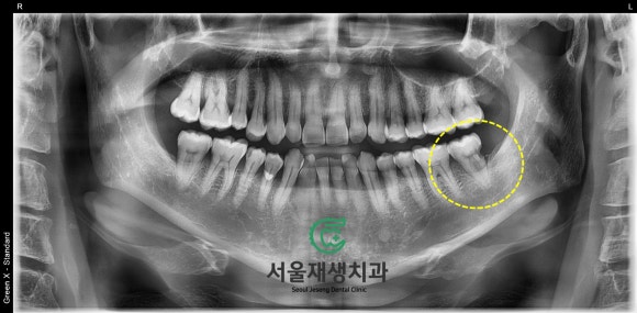 치아 뿌리에 생긴 충치...살릴 수 있는 방법 없을까요? 현미경을 이용하여 보다 꼼꼼하게! 관련 이미지 4