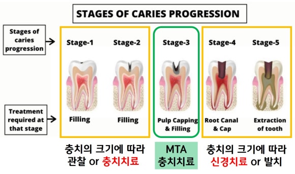 [MTA충치치료] 충치가 클 때.. 신경치료 안하고 치료하는 법 (치수복조술, 신촌 서울재생치과) 관련 이미지 7
