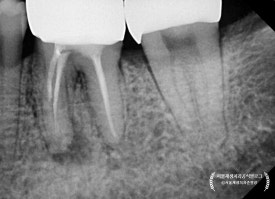 [재신경치료] 예전에 신경치료 받은 치아가 갑자기 붓고 아파요! (현미경을 통해 정확하고 섬세하게 재신경치료 하기) 관련 이미지 24