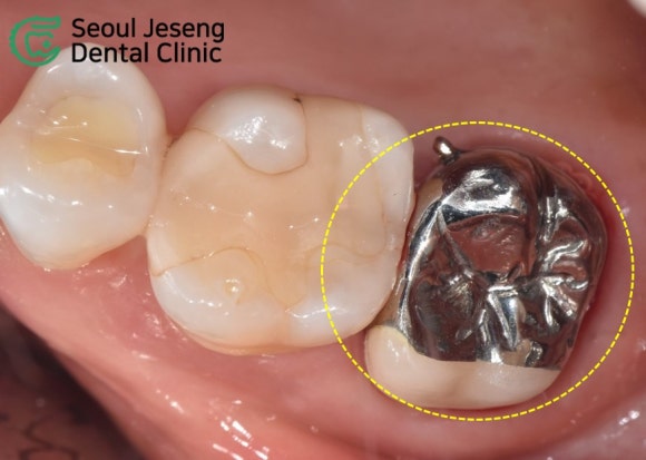 [재신경치료] 타치과에서 재신경치료 하는 중인데 발치를 하자고 했어요... (서울재생치과 현미경 신경치료) 관련 이미지 11