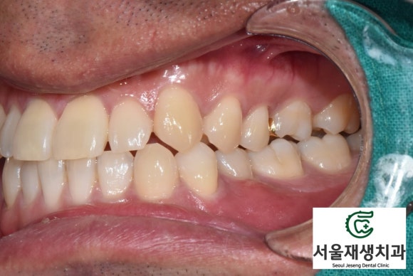 [치외치신경치료] 뿌리 끝 염증이 커서 발치해야된대요! 치아 머리에 볼~록! 알고보면 무서운 작은 혹 (서울재생치과) 관련 이미지 4