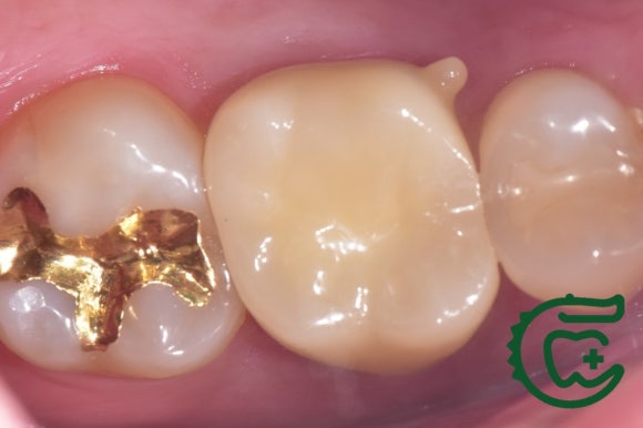 [재신경치료] 다른 치과에서 재신경치료했는데 여전히 불편해요. 40대 남성 환자분의 재재신경치료 이야기. 관련 이미지 8